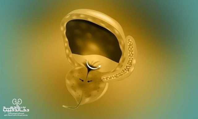 طرق علاج تضخم البروستاتا مع دكتور خالد حبيب