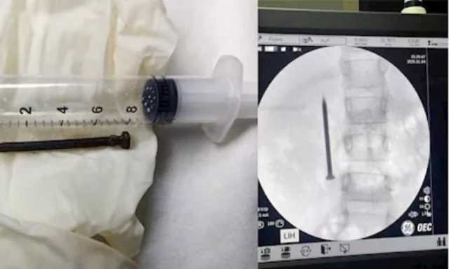 فريق طبي بجامعة المنوفية ينجح في استخراج مسمار حاد من أمعاء طفلة