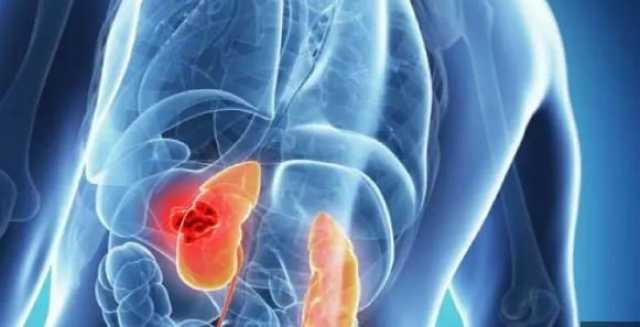 «خمسة لصحتك».. سبب الإصابة بـ حصوات الكلى وزيادة الأملاح وطرق الوقاية