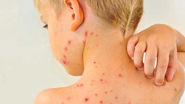 بعد انتشار الحصبة في 25 ولاية أمريكية.. كيف نحمي أطفالنا من العدوى والأمراض؟