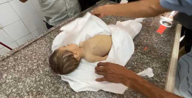 وفاة طفلة بسبب الجوع في قطاع غزة