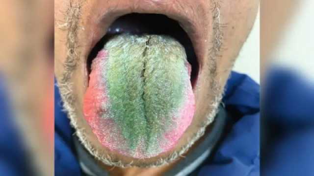 “نبت الشعر على لسانه”.. من مثل عربي إلى واقع أمريكي صادم!