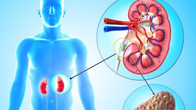 7 أعراض تشير إلى إصابتك بحصى الكلى.. ما هي؟