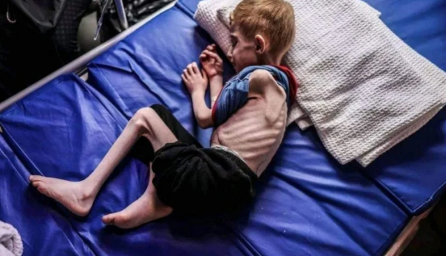 وفاة 57 طفلاً في غزة بسبب سوء التغذية