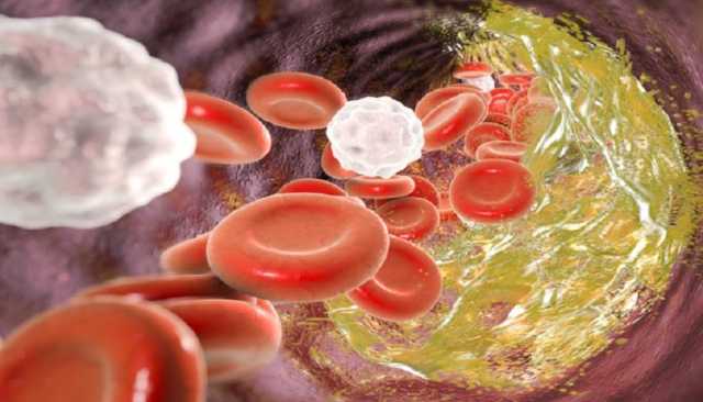 حقائق هامة حول الكوليسترول.. ما الذي يجب أن تعرفه عن صحته وأثره على قلبك؟