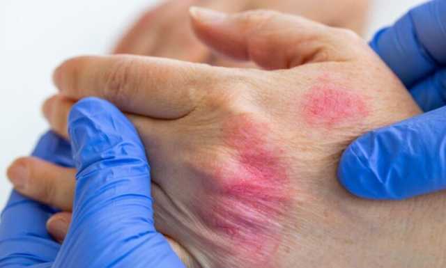 تطوير نموذج ذكاء اصطناعي لتشخيص مرض جلدي خطير