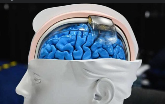شريحة في الدماغ تترجم الأفكار بطريقة فورية إلى كلام
