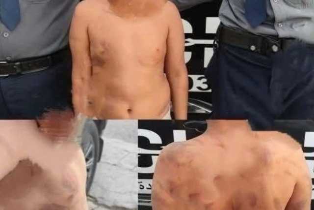 جلده يروي القصة.. طفل ينجو من جحيم زوج الأم في كركوك