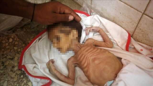 آخرهم كندة وجوري ونضال.. ارتفاع 'شهداء' الجوع من أطفال غزة إلى 66