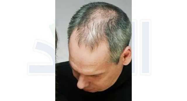اكتشاف علاج طبيعي لتساقط الشعر