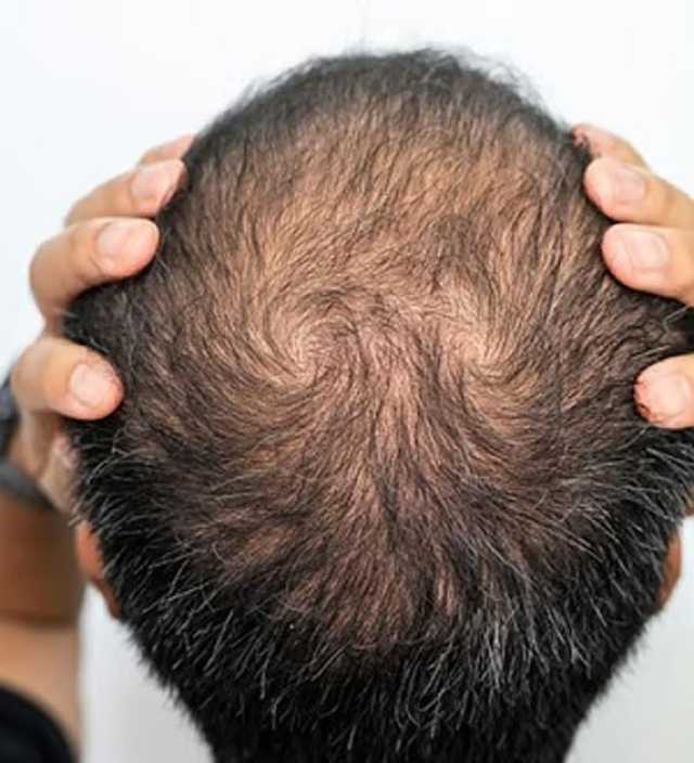 عادة بسيطة عند النوم قد تؤدي إلى الصلع