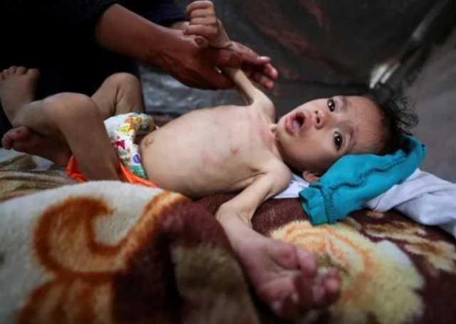وفاة 100 طفل في غزة جراء التجويع الإسرائيلي