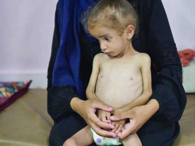 أجساد هزيلة تصارع الموت في ظل انعدام حليب الأطفال بغزة