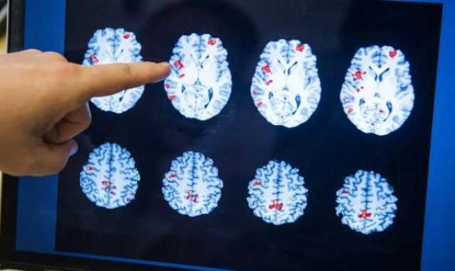 صعود مفاجئ في حالات التدهور العقلي يثير القلق داخل أمريكا