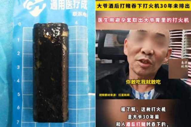 كشف لُغز 'النيران الصامتة' في معدة 'ستيني صيني'