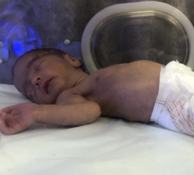مجمع ناصر: أطفال غزة يمرون في أشد مرحلة من سوء التغذية