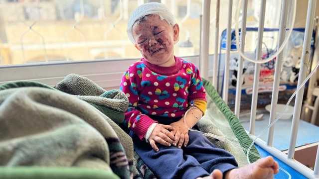 أطباء بلا حدود: 100 مصاب بحروق يوميا في قطاع غزة