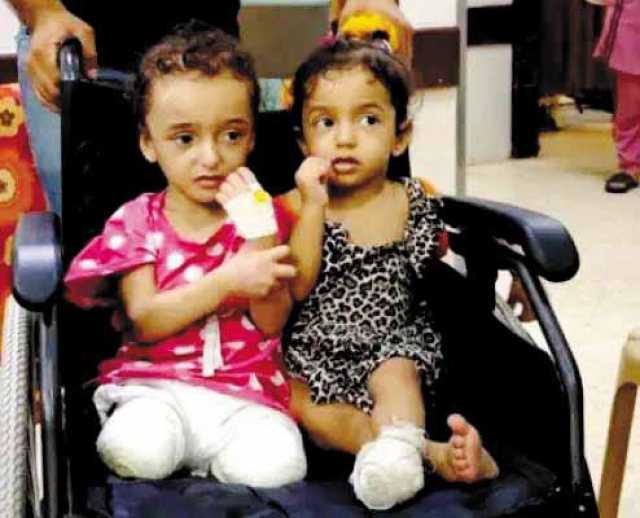 مبتورو الأطراف في غزة.. معاناة تتفاقم مع الحصار والإبادة الإسرائيلية