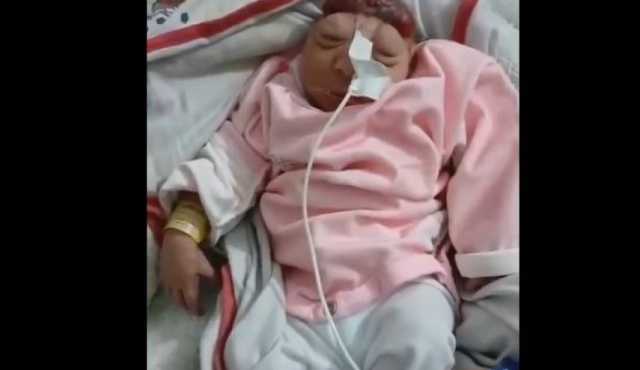 ولادة طفلة “بلا دماغ” في غزة بسبب إشعاعات القصف الصهيوني