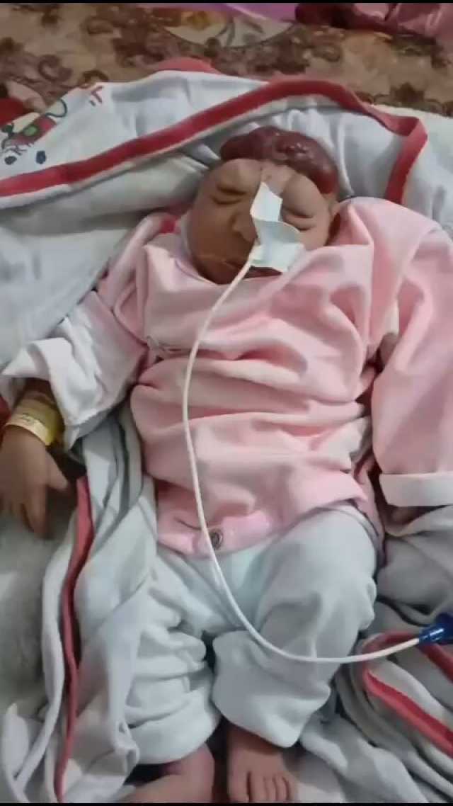 بسبب الغازات السامة للصواريخ الإسرائيلية.. ارتفاع تشوهات الأجنة بين النساء الحوامل في غزة