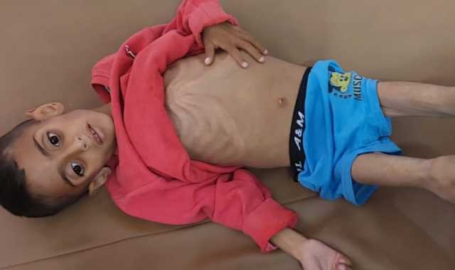 “حماس”: 66 طفلاً في غزة توفوا منذ مارس بمضاعفات المجاعة الناتجة عن الحصار الصهيوني
