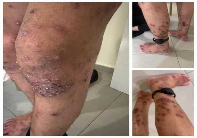 تحذيرات من تفشي “سكايبوس” في سجن “مجدّو” وسط إهمال طبي متعمد بحق الأسرى الفلسطينيين