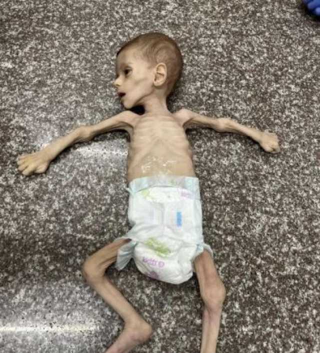 استشهاد طفلة فلسطينية بسبب الجوع وسوء التغذية في غزة