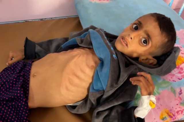 “صحة غزة”: وفاة خمس حالات خلال الـ24 ساعة الماضية نتيجة المجاعة