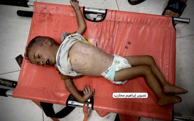 3 وفيات جديدة ترفع حصيلة سوء التغذية والمجاعة بغزة إلى 154 حالة