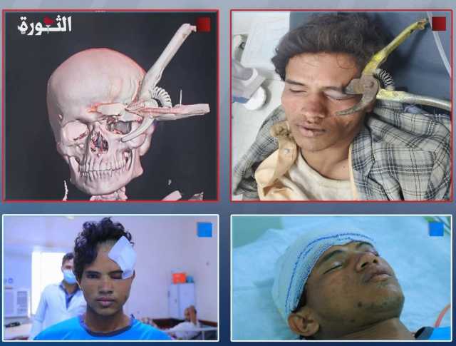 فريق طبي بمستشفى الثورة في الحديدة ينقذ شاباً بتدخل جراحي معقد