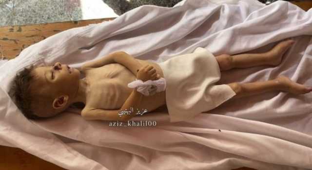 استشهاد طفل في غزة جراء سوء التغذية