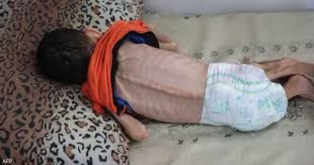 ارتفاع وفيات الأطفال في غزة بنسبة 230% بسبب سوء التغذية