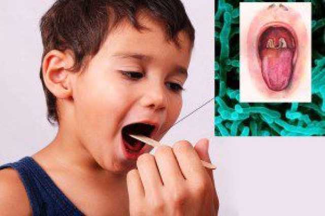 تفشي وباء الدفتيريا في شبوة وإغلاق المدارس بعد حالات وفاة