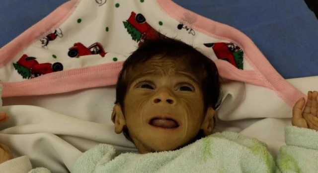 “يونيسف” تحذر من تفشي الأمراض بين أطفال غزة وتدعو لتكثيف المساعدات الإنسانية