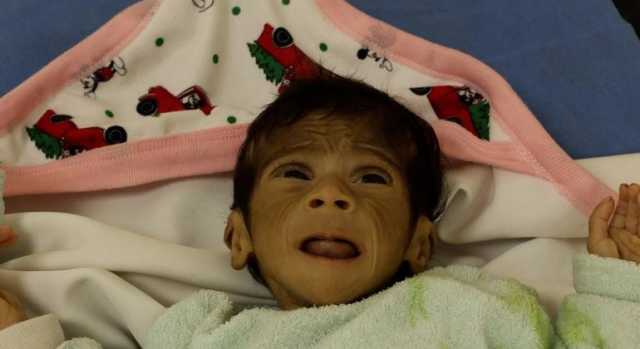 “يونيسف” تحذر من تفشي الأمراض بين أطفال غزة وتدعو لتكثيف المساعدات الإنسانية