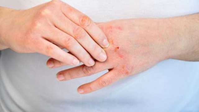 مضاعفات الصدفية تختلف حدتها من شخص لآخر.. هل لها علاج؟