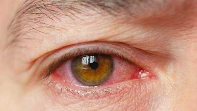 ما مرض التراخوما؟.. التهاب بكتيري في العين يهدد الملايين بالعمى