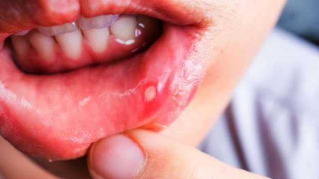 أفضل طريقة لعلاج قرح الفم في المنزل.. تُخلصك من الألم نهائيا
