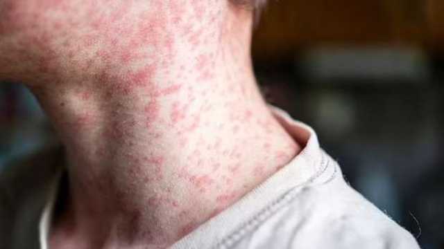 تفشي مرض الحصبة المعدي بولاية تكساس.. وارتفاع عدد الإصابات