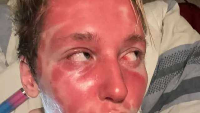 «إبرة فيلر» تصيب فتى بريطاني بحروق وصدفية.. حقنة تجميل أم لعنة دائمة؟