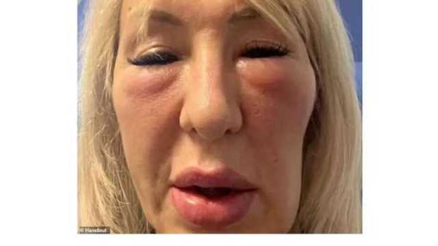 حشوات تجميلية تدمر وجه سيدة بريطانية.. صور تكشف تشوهات مرعبة