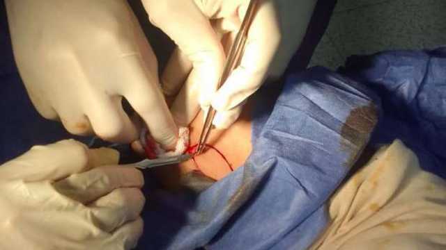 إجراء أول جراحة تجميل في مستشفى الضبعة المركزي بمطروح