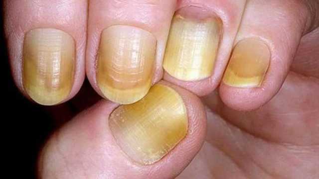 أظافرك الصفراء مؤشر لمرض خطير.. اذهب للطبيب عند ظهور هذه الأعراض