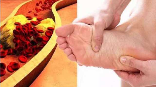 3 تمارين تساعدك على تقليل خطر الإصابة بارتفاع الكوليسترول.. اهتم بصحتك