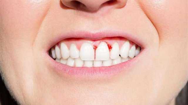 تفسير حلم نزيف الأسنان للحامل والمتزوجة.. خير أم شر يقترب؟
