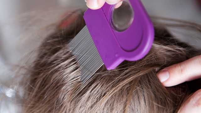 فطريات فروة الرأس… كيف تنتقل وما هي أعراضها؟