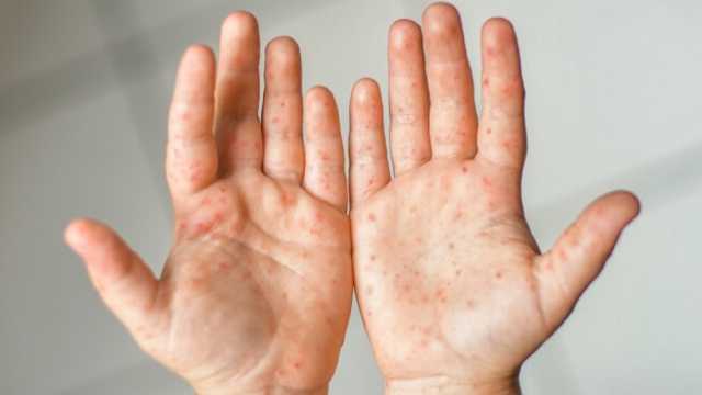 استشارية توضح أعراض عدوى فيروسية تشيع بين الأطفال..فيديو