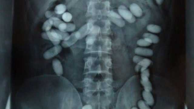 السجن 10 سنوات لآسيوي هرب مخدرات داخل أحشائه