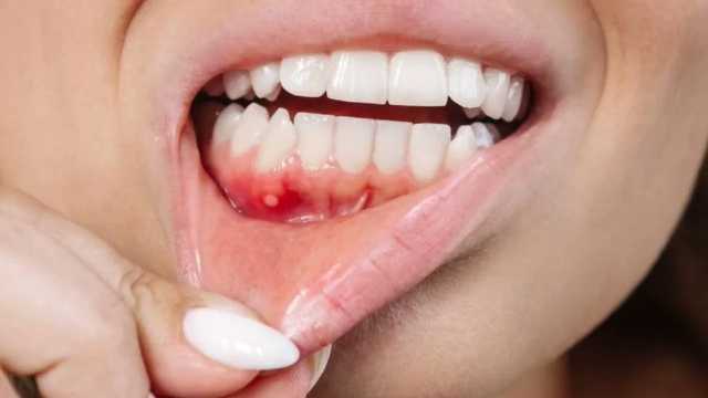 تحذير طبي: أعراض بسيطة قد تخفي أخطر أنواع سرطان الفم
