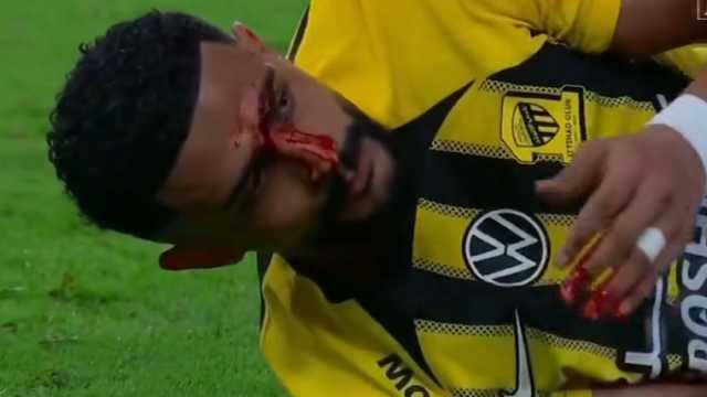 إصابة عبدالإله العمري في الأنف خلال مباراة الاتحاد.. فيديو